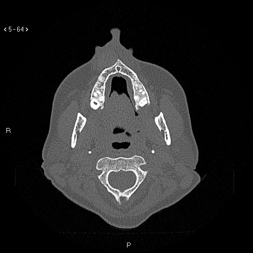 Nasolabial cyst (Radiopaedia 75125-86194 Axial bone window 25).jpg