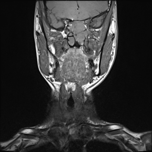 File:Nasopharyngeal carcinoma with skull base invasion (Radiopaedia 53415-59485 Coronal T1 26).jpg