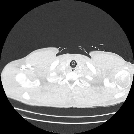 Near-drowning pulmonary edema (Radiopaedia 59457-66814 Axial lung window 1).jpg