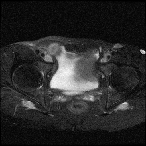 File:Necrotizing epididymo-orchitis with intra-testicular abscess (Radiopaedia 29397-29860 Axial T2 fat sat 2).jpg