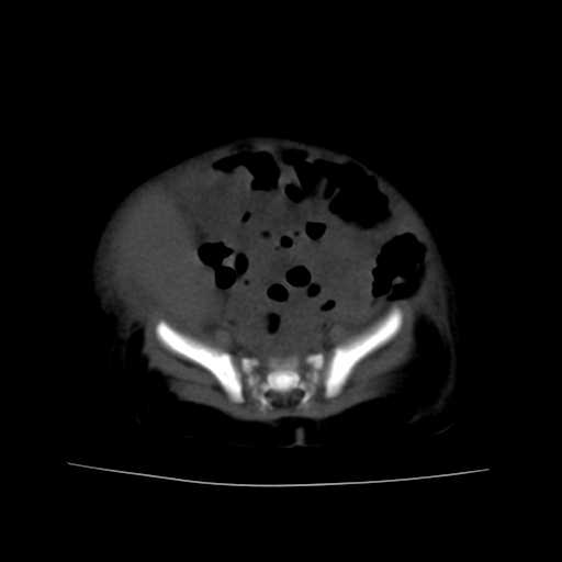 File:Neuroblastoma (Radiopaedia 20876-20799 Axial non-contrast 20).jpg