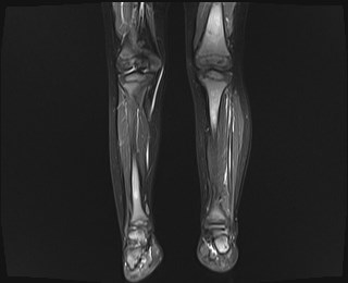 File:Neuroblastoma with bone metastases (Radiopaedia 67080-76414 B 8).jpg