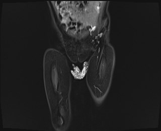 File:Neuroblastoma with bone metastases (Radiopaedia 67080-76414 Coronal STIR 3).jpg