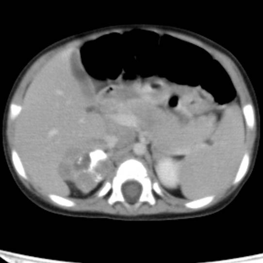 Neuroblastoma with skull metastases (Radiopaedia 30326-30960 C 17).jpg