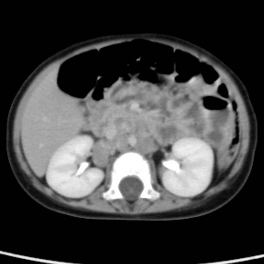 Neuroblastoma with skull metastases (Radiopaedia 30326-30960 C 27).jpg