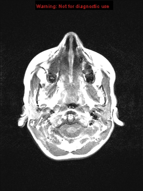 File:Neurofibromatosis type 1 with optic nerve glioma (Radiopaedia 16288-15965 Axial T1 24).jpg