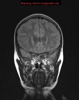 File:Neurofibromatosis type 1 with optic nerve glioma (Radiopaedia 16288-15965 Coronal FLAIR 18).jpg