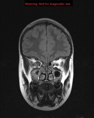 File:Neurofibromatosis type 1 with optic nerve glioma (Radiopaedia 16288-15965 Coronal FLAIR 20).jpg