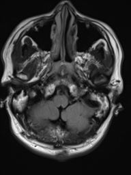 File:Neurofibromatosis type 2 (Radiopaedia 44936-48838 Axial FLAIR 3).png