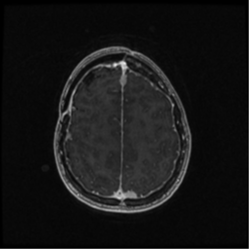 Neurofibromatosis type 2 (Radiopaedia 45229-49244 Axial T1 C+ 90).png