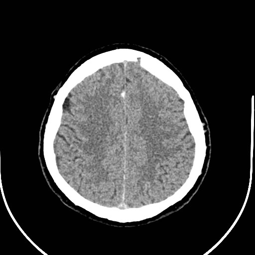 Neurofibromatosis type 2 (Radiopaedia 79097-92047 Axial non-contrast 46).jpg