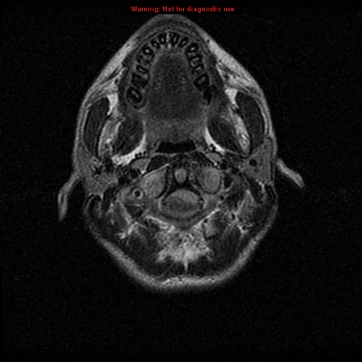 File:Neurofibromatosis type 2 (Radiopaedia 8953-9730 Axial FLAIR 3).jpg