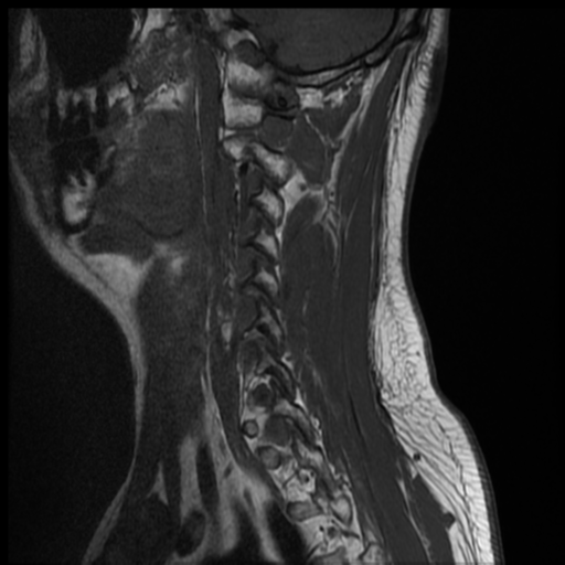 File:Neurofibromatosis type 2 (spinal manifestations) (Radiopaedia 53943-60070 Sagittal T1 2).png