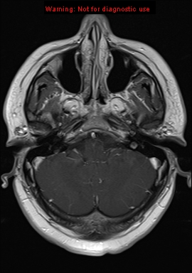 File:Neuroglial cyst (Radiopaedia 10713-11184 Axial T1 C+ 19).jpg