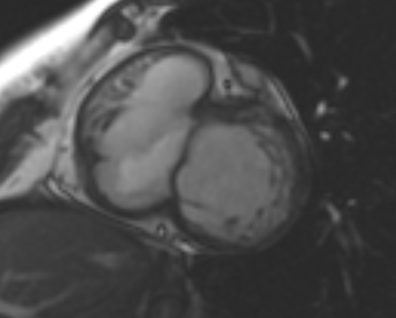 File:Non-compaction of the left ventricle (Radiopaedia 69436-79314 Short axis cine 174).jpg