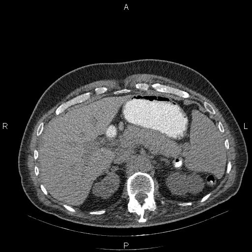 File:Non Hodgkin lymphoma in a patient with ankylosing spondylitis (Radiopaedia 84323-99624 Axial non-contrast 34).jpg
