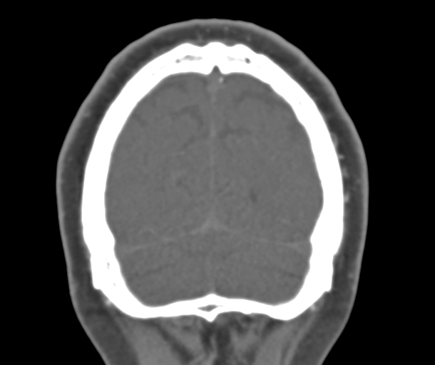 File:Normal CTA head (Radiopaedia 40801-43464 B 83).png