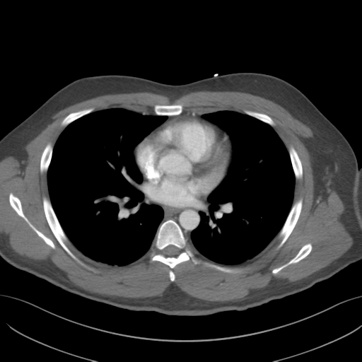 File:Normal CTA thorax (non ECG gated) (Radiopaedia 41750-44704 A 51).png