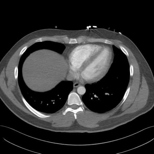 File:Normal CTA thorax (non ECG gated) (Radiopaedia 41750-44704 A 68).png