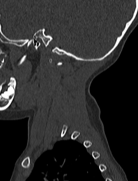 Normal CT cervical spine - pediatric (Radiopaedia 52549-58462 Sagittal bone window 211).jpg