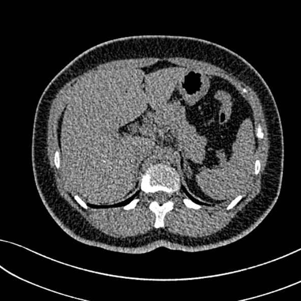 Normal CT chest- adult female (Radiopaedia 52522-58428 Axial non-contrast 132).jpg