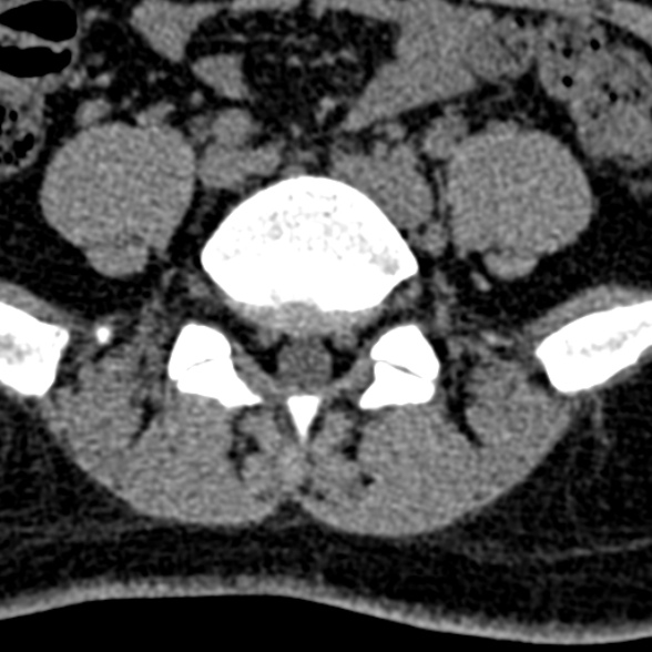 Normal CT lumbar spine (Radiopaedia 53981-60118 Axial non-contrast 83).jpg