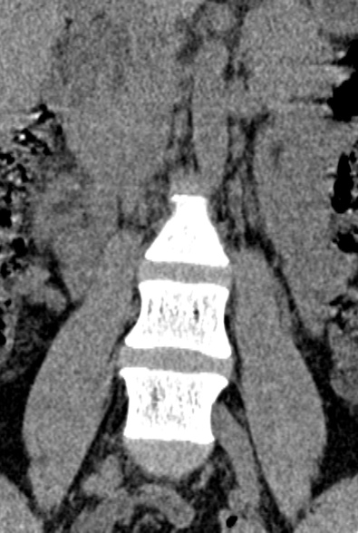 Normal CT lumbar spine (Radiopaedia 53981-60118 F 14).jpg