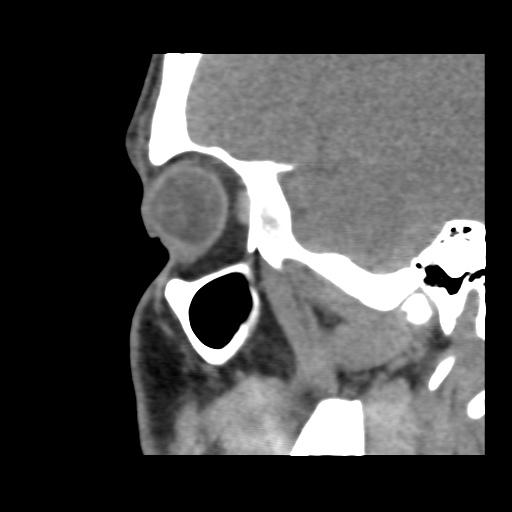 Normal CT paranasal sinuses (Radiopaedia 42286-45390 F 41).jpg