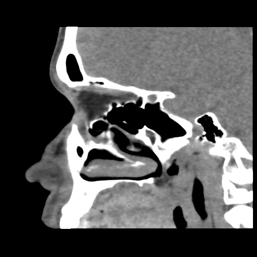 Normal CT paranasal sinuses (Radiopaedia 42286-45390 F 91).jpg