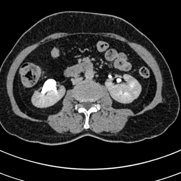 File:Normal CT split bolus study of the renal tract (Radiopaedia 48631-53634 Axial split bolus 109).jpg