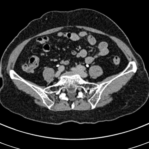 File:Normal CT split bolus study of the renal tract (Radiopaedia 48631-53634 Axial split bolus 200).jpg