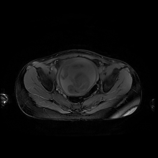 File:Normal MRI abdomen in pregnancy (Radiopaedia 88001-104541 D 47).jpg
