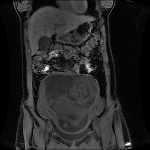 Normal MRI abdomen in pregnancy (Radiopaedia 88001-104541 M 51).jpg