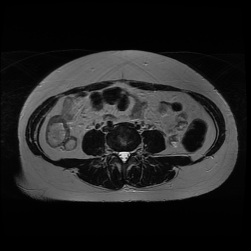 Normal MRI abdomen in pregnancy (Radiopaedia 88005-104548 Axial T2 5).jpg