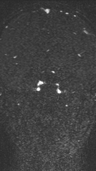 Normal MRI brain with MRV- teenager (Radiopaedia 49425-54553 Coronal MRV 125).jpg
