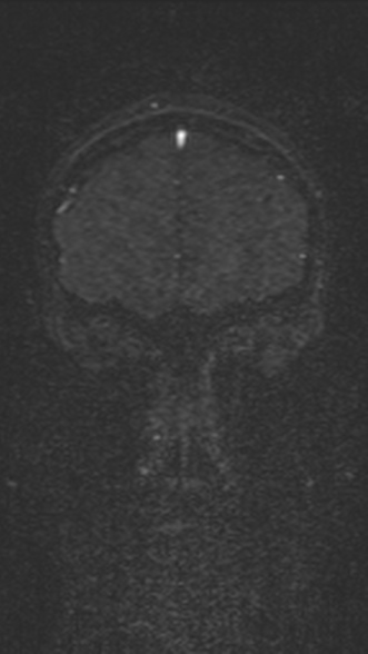 Normal MRI brain with MRV- teenager (Radiopaedia 49425-54553 Coronal MRV 52).jpg