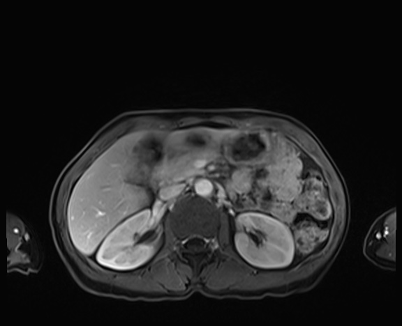 Normal adrenal glands MRI (Radiopaedia 82017-96004 K 36).jpg