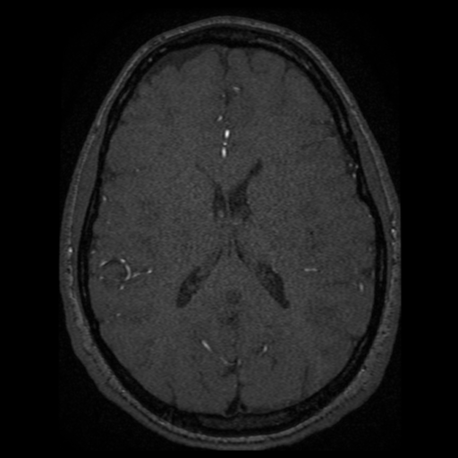 Normal brain MRA (Radiopaedia 41046-43793 Axial MRA 3).png