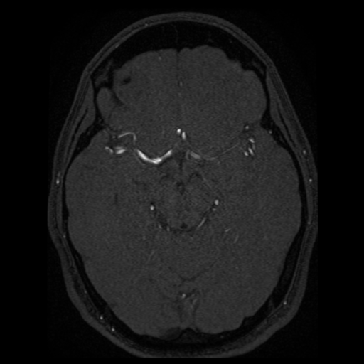 Normal brain MRA (Radiopaedia 41046-43793 Axial MRA 49).png
