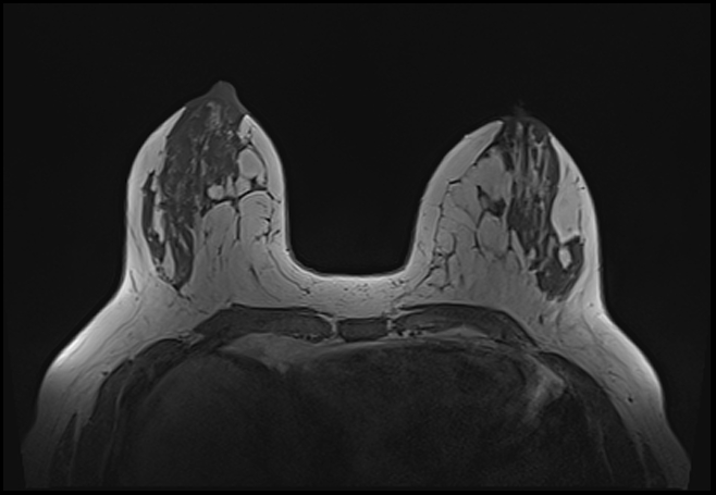 File:Normal breast MRI - dense breasts (Radiopaedia 80454-93850 Axial T1 85).jpg