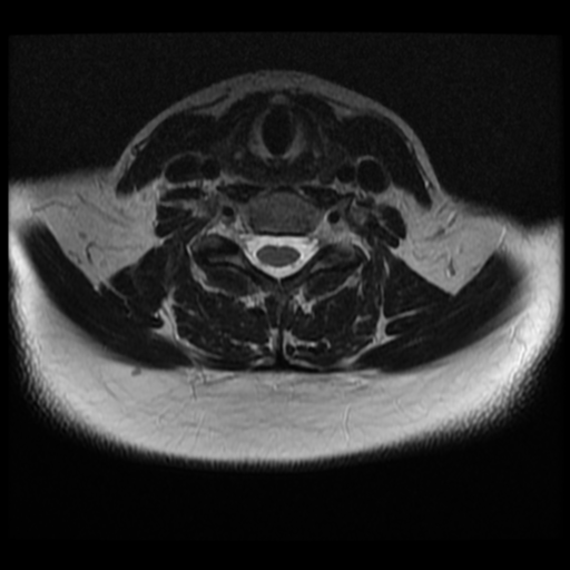 File:Normal cervical and thoracic spine MRI (Radiopaedia 35630-37156 Axial T2 14).png