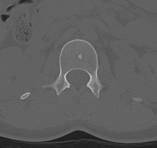 File:Normal lumbar spine CT (Radiopaedia 46533-50986 Axial bone window 10).png