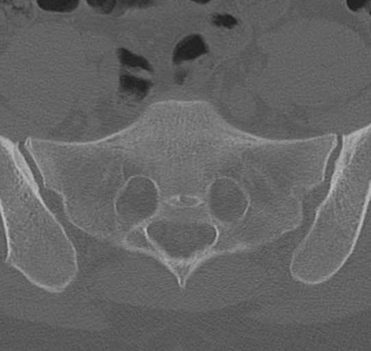 File:Normal lumbar spine CT (Radiopaedia 46533-50986 Axial bone window 71).png