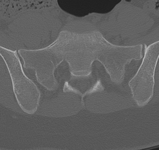 File:Normal lumbosacral CT (Radiopaedia 37923-39867 Axial bone window 84).png