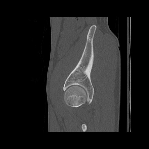 Normal pelvis (Radiopaedia 51473-57238 Sagittal bone window 114).jpg