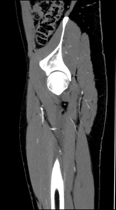 Normal pelvis CT angiogram (Radiopaedia 84966-100481 C 24).jpg