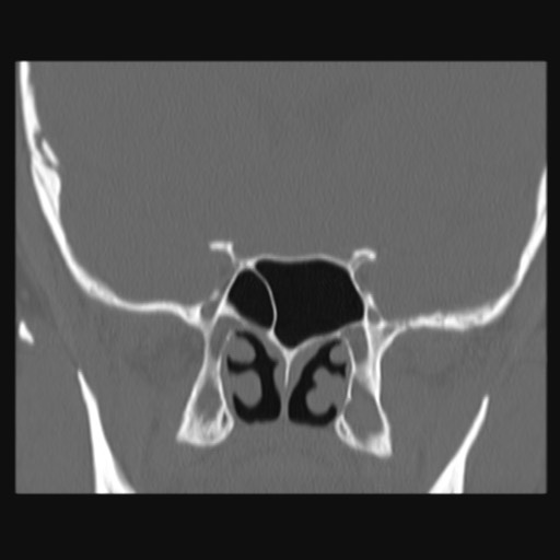 Normal sinus CT (annotated) (Radiopaedia 78917-91810 Coronal bone window 41).jpg