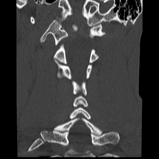 File:Normal trauma cervical spine (Radiopaedia 41017-43760 Coronal bone window 24).png