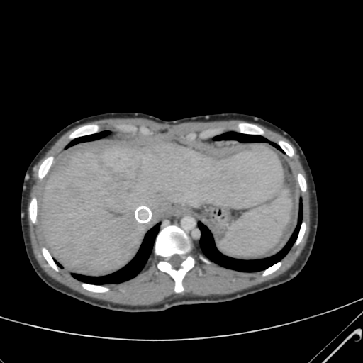 File:Nutmeg liver- Budd-Chiari syndrome (Radiopaedia 46234-50635 B 10).png