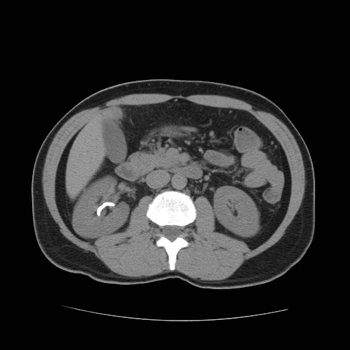 File:Obstructed kidney with perinephric urinoma (Radiopaedia 26889-27067 Axial non-contrast 12).jpg